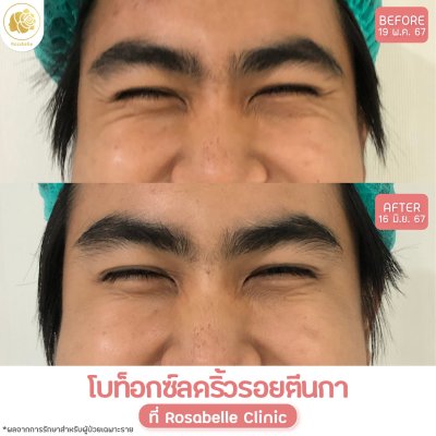 รีวิวโปรแกรมฉีดโบท็อกซ์ลดริ้วรอย