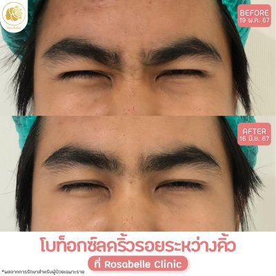รีวิวโปรแกรมฉีดโบท็อกซ์ลดริ้วรอย