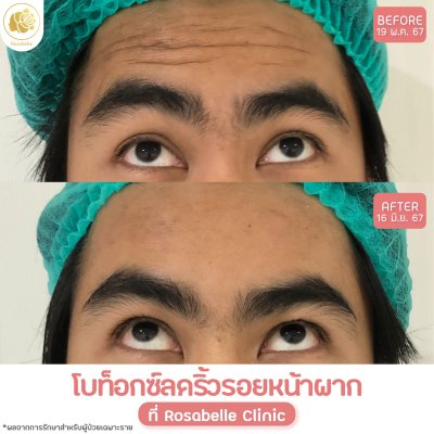 รีวิวโปรแกรมฉีดโบท็อกซ์ลดริ้วรอย