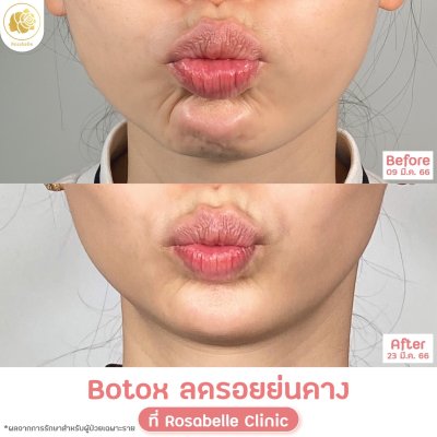 รีวิวโปรแกรมฉีดโบท็อกซ์ลดริ้วรอย