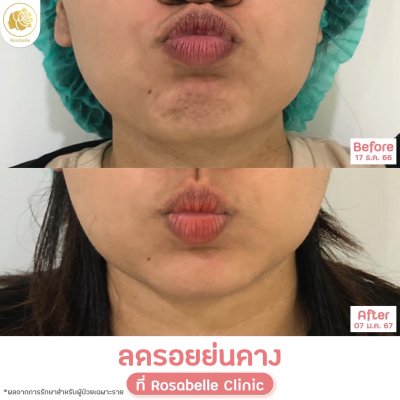 รีวิวโปรแกรมฉีดโบท็อกซ์ลดริ้วรอย