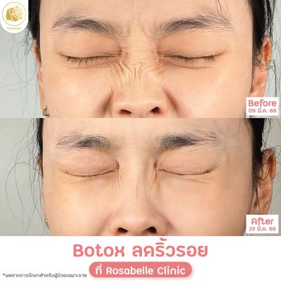 รีวิวโปรแกรมฉีดโบท็อกซ์ลดริ้วรอย