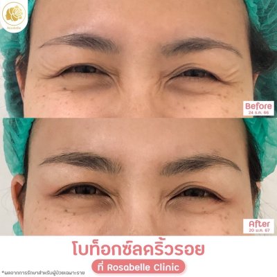 รีวิวโปรแกรมฉีดโบท็อกซ์ลดริ้วรอย