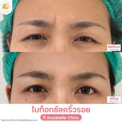 รีวิวโปรแกรมฉีดโบท็อกซ์ลดริ้วรอย