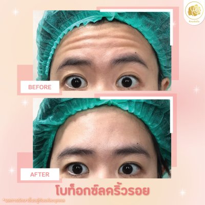 รีวิวโปรแกรมฉีดโบท็อกซ์ลดริ้วรอย