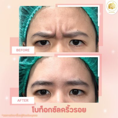 รีวิวโปรแกรมฉีดโบท็อกซ์ลดริ้วรอย