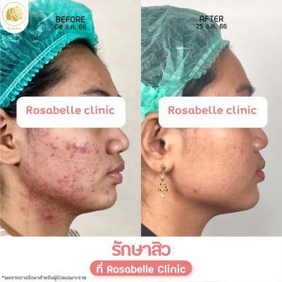 รีวิวรักษาสิว