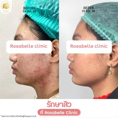 รีวิวรักษาสิว