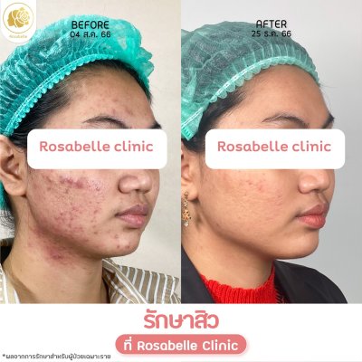 รีวิวรักษาสิว