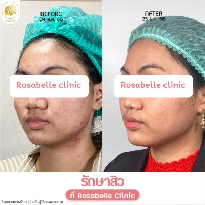 รีวิวรักษาสิว