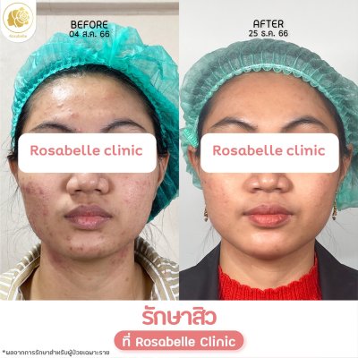 รีวิวรักษาสิว