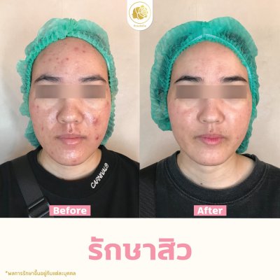 รีวิวรักษาสิว