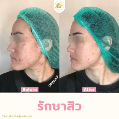 รีวิวรักษาสิว