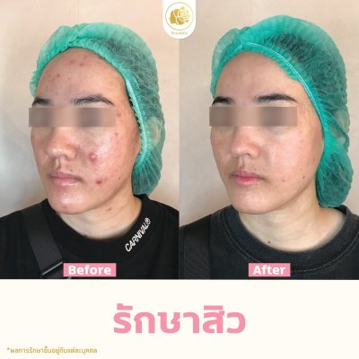 รีวิวรักษาสิว