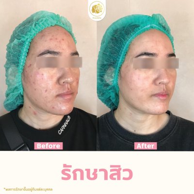 รีวิวรักษาสิว