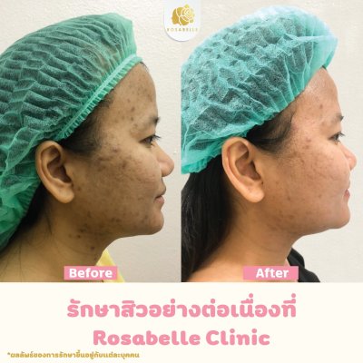 รีวิวรักษาสิว