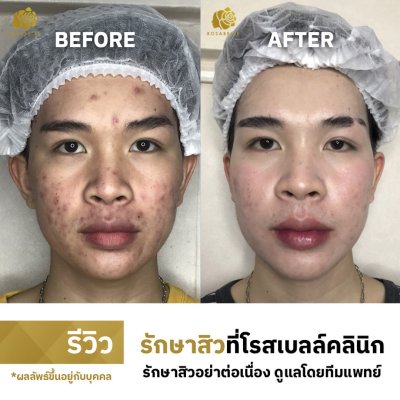 รีวิวรักษาสิว