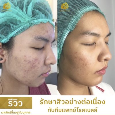 รีวิวรักษาสิว