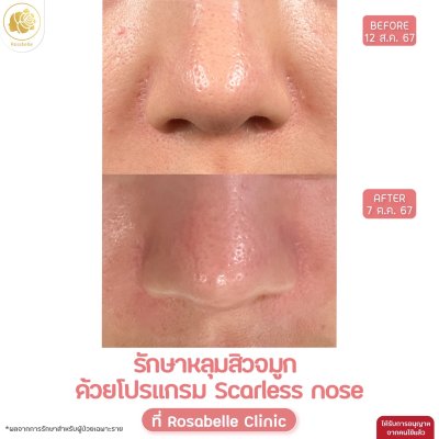 รักษาหลุมสิวจมูก