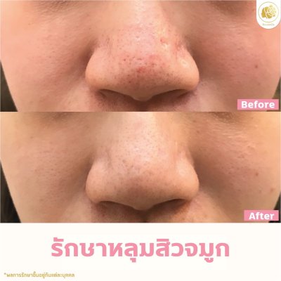 รักษาหลุมสิวจมูก