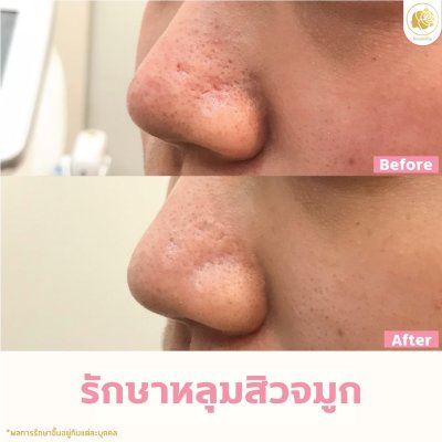 รักษาหลุมสิวจมูก