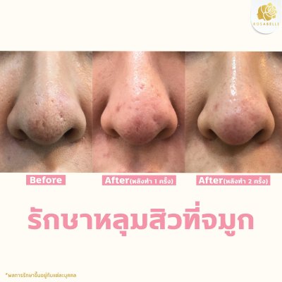 รักษาหลุมสิวจมูก