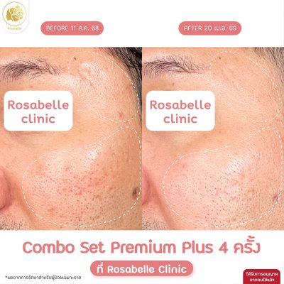 รีวิวโปรแกรม Combo Set Premium Plus หลุมสิว
