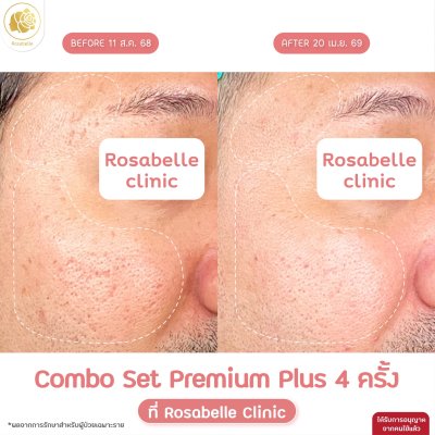 รีวิวโปรแกรม Combo Set Premium Plus หลุมสิว