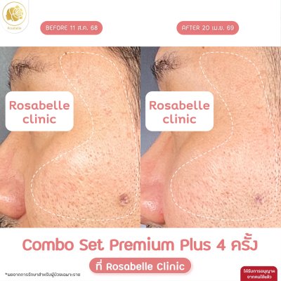 รีวิวโปรแกรม Combo Set Premium Plus หลุมสิว