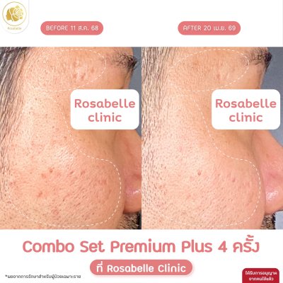 รีวิวโปรแกรม Combo Set Premium Plus หลุมสิว