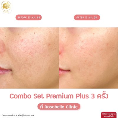 รีวิวโปรแกรม Combo Set Premium Plus หลุมสิว