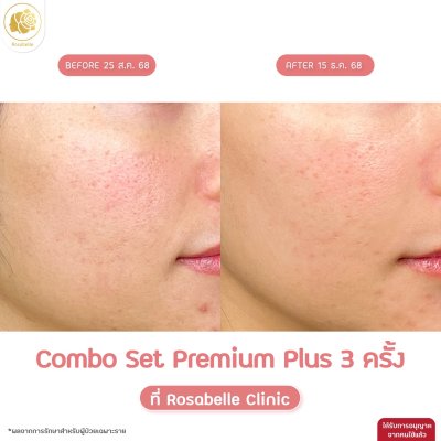 รีวิวโปรแกรม Combo Set Premium Plus หลุมสิว