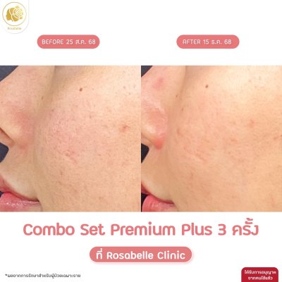 รีวิวโปรแกรม Combo Set Premium Plus หลุมสิว