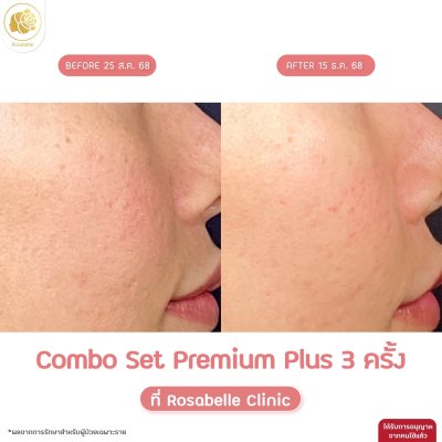 รีวิวโปรแกรม Combo Set Premium Plus หลุมสิว