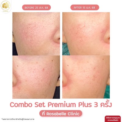 รีวิวโปรแกรม Combo Set Premium Plus หลุมสิว