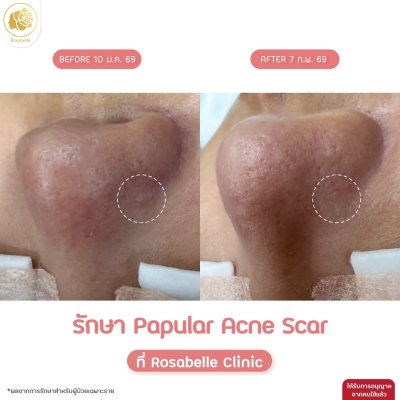 Papular Acne Scar