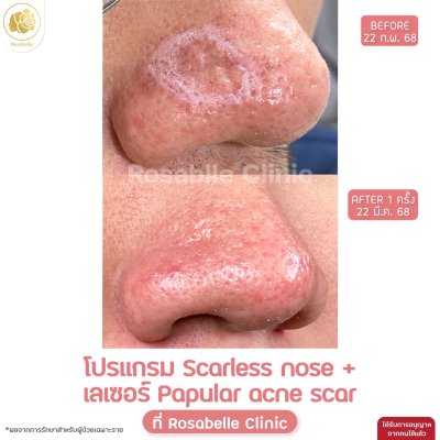 Papular Acne Scar