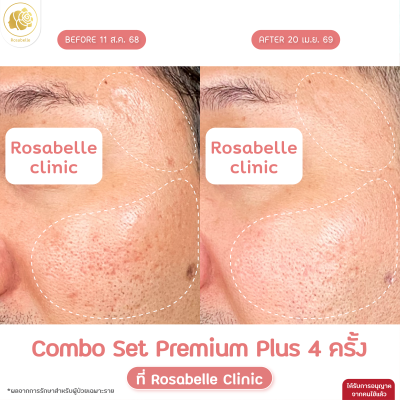 รีวิวโปรแกรม Combo Set Premium Plus หลุมสิว