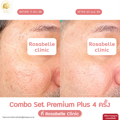 รีวิวโปรแกรม Combo Set Premium Plus หลุมสิว