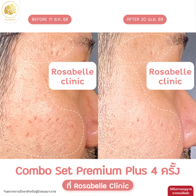 รีวิวโปรแกรม Combo Set Premium Plus หลุมสิว