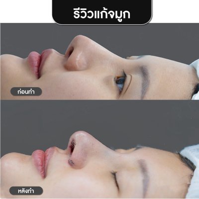 รีวิวศัลยกรรมจมูก