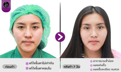 รีวิวศัลยกรรมตา