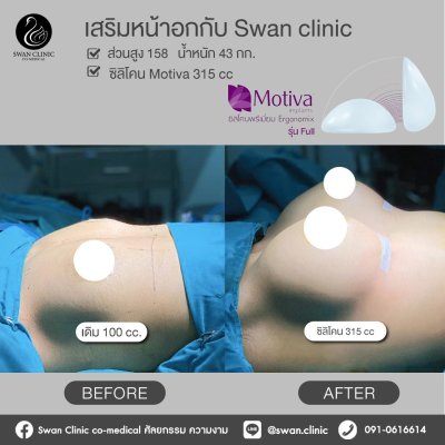 รีวิวศัลยกรรมหน้าอก