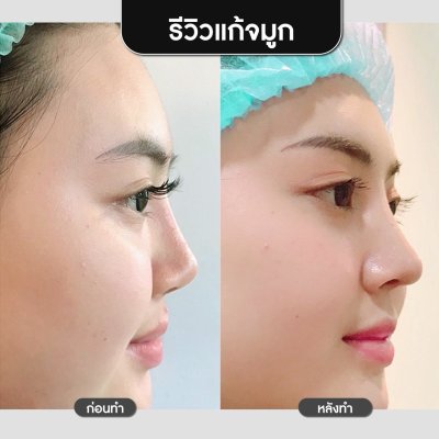 รีวิวศัลยกรรมจมูก