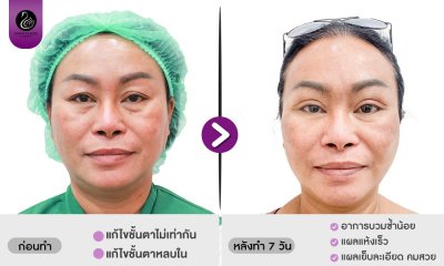 รีวิวศัลยกรรมตา