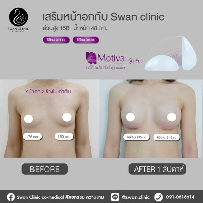 รีวิวศัลยกรรมหน้าอก