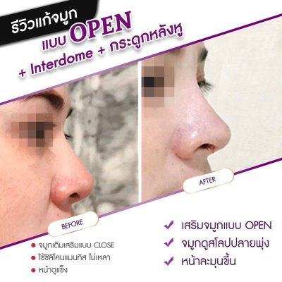 รีวิวศัลยกรรมจมูก