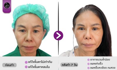 รีวิวศัลยกรรมตา
