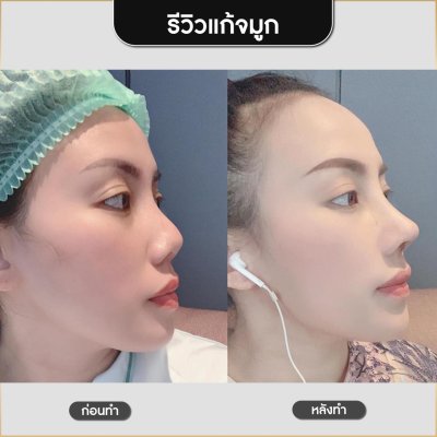 รีวิวศัลยกรรมจมูก