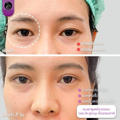 รีวิวศัลยกรรมตา